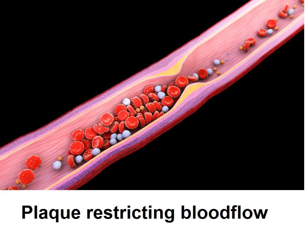 Plaque restricting bloodflow